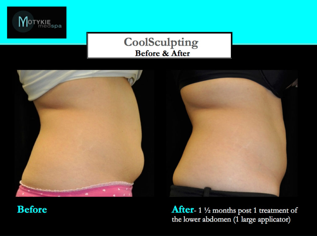 Does Coolsculpting Really Work?