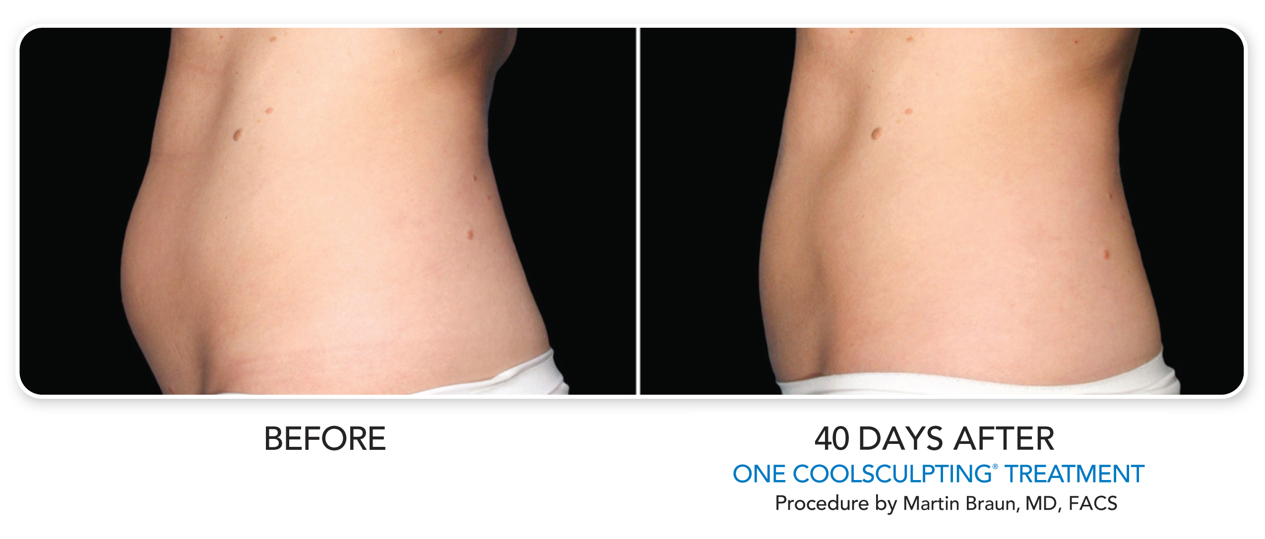 CoolSculpting vs. VelaShape Body Contouring