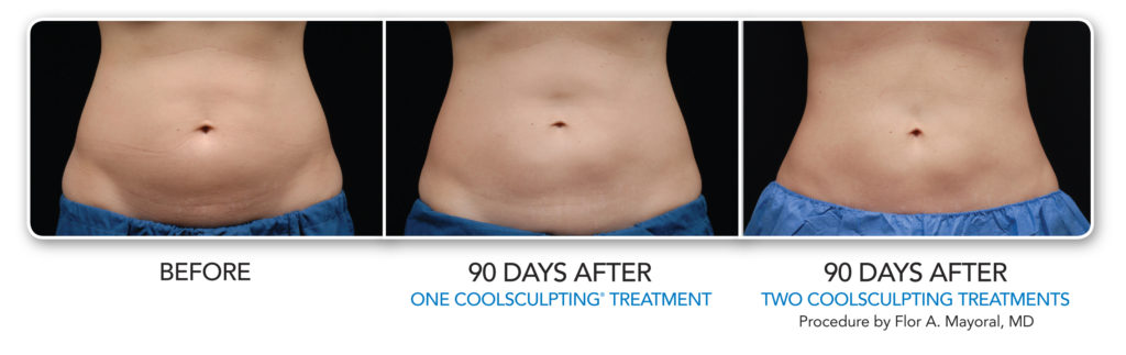 What is CoolSculpting?