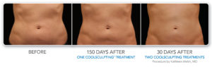 How much fat can I lose after CoolSculpting?