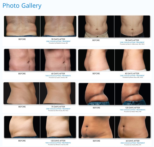 CoolSculpting Stomach Skin Tightening Procedures in Beverly Hills