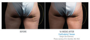 Non-Surgical Fat Reduction Treatment in Los Angeles