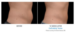 CoolSculpting for the Inner and Outer Thigh