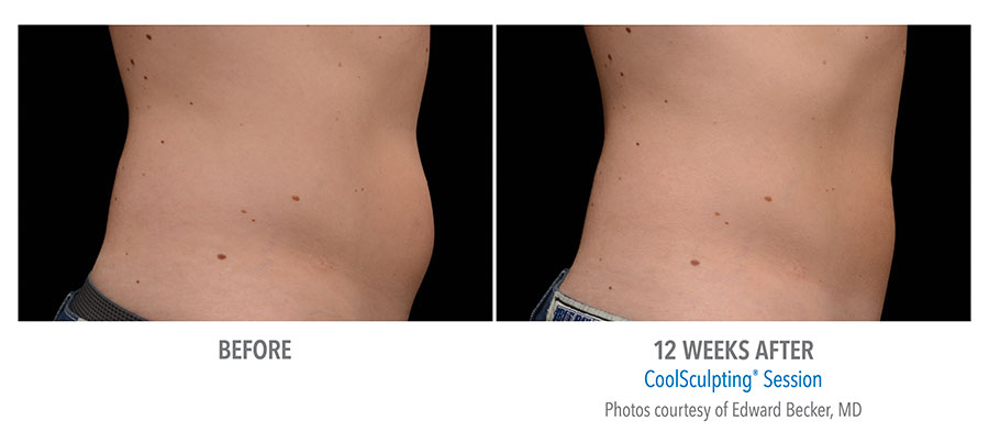CoolSculpting Beverly Hills Body Sculpting Med Spa