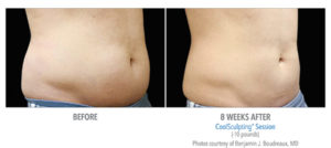 What does CoolSculpting Treat?