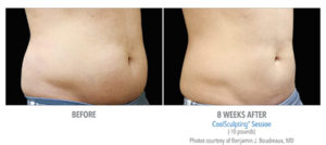 Non-Surgical Fat Reduction Treatment in Los Angeles