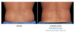 Non-Surgical Fat Reduction Treatment in Los Angeles
