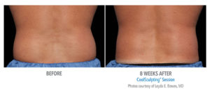 CoolSculpting vs. UltraShape