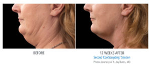Kybella Injections vs. CoolSculpting CoolMini for Chin Fat Reduction