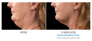 CoolSculpting Before & After Photo Gallery