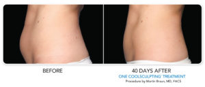 Non-Surgical Fat Reduction Treatment – CoolSculpting