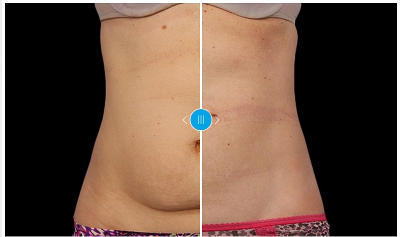 Liposuction vs CoolSculpting - Heights Plastic Surgery