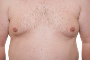 Use CoolSculpting to Reduce Fat on Male Chests (Pseudogynecomastia)