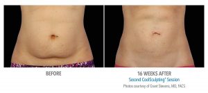 Does fat freezing with Coolsculpting work?