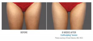 Does fat freezing with Coolsculpting work?