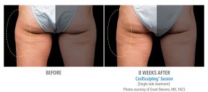 Does fat freezing with Coolsculpting work?