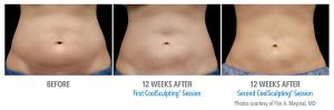 Harvard Calls CoolSculpting a “Cool Procedure”: Over 8 Million CoolSculpting Treatments