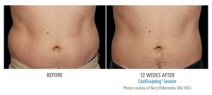 Men Are Turning to CoolSculpting to Get Rid of Stubborn Belly Fat 