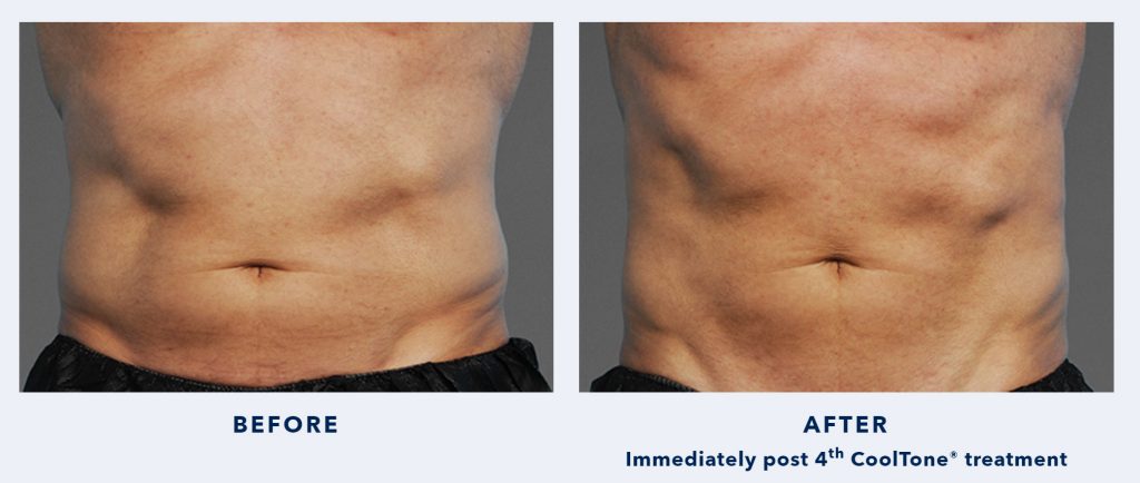 CoolSculpting&#8217;s CoolTone Muscle Toning Before And After Photos