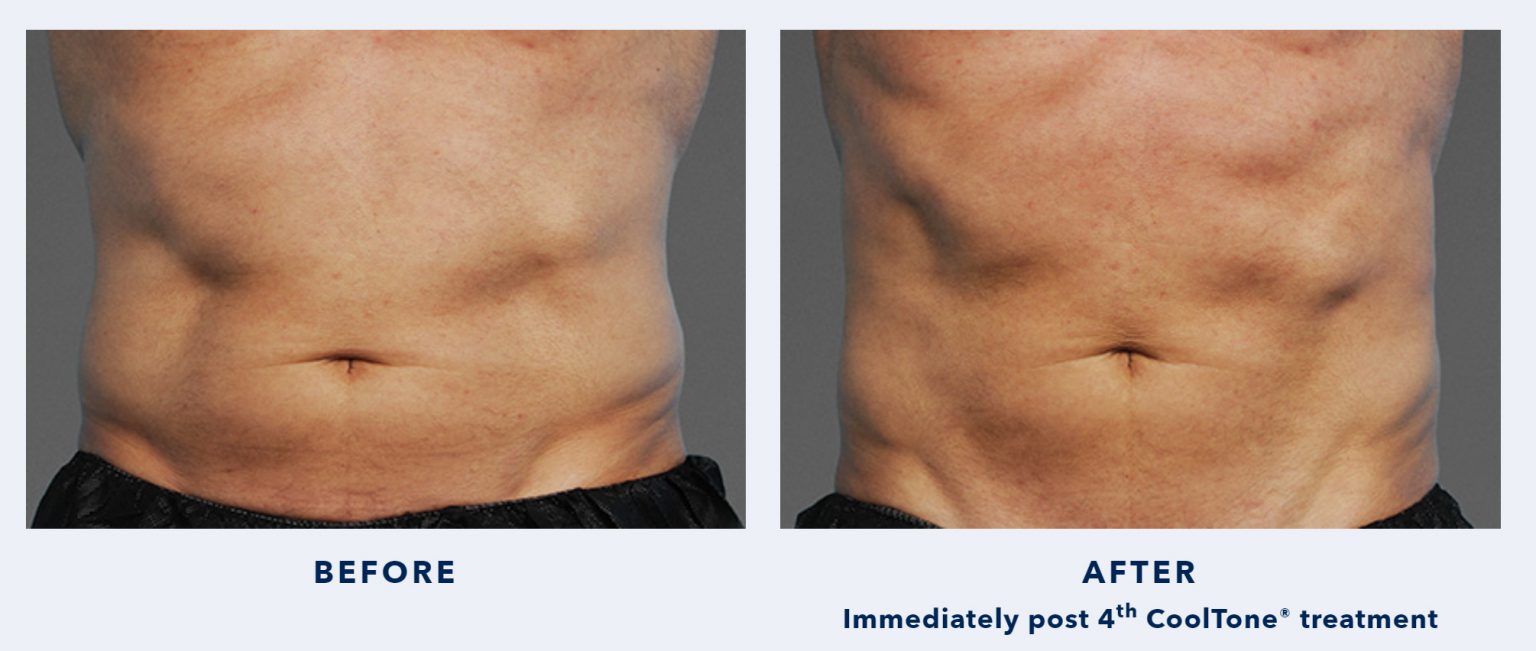CoolSculpting CoolTone Muscle Toning Before After Photos Beverly Hills CA