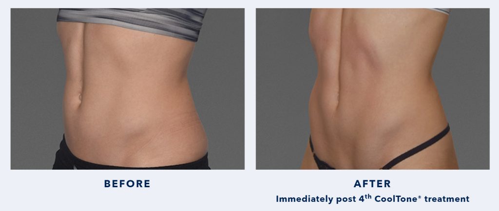 CoolSculpting&#8217;s CoolTone Muscle Toning Before And After Photos