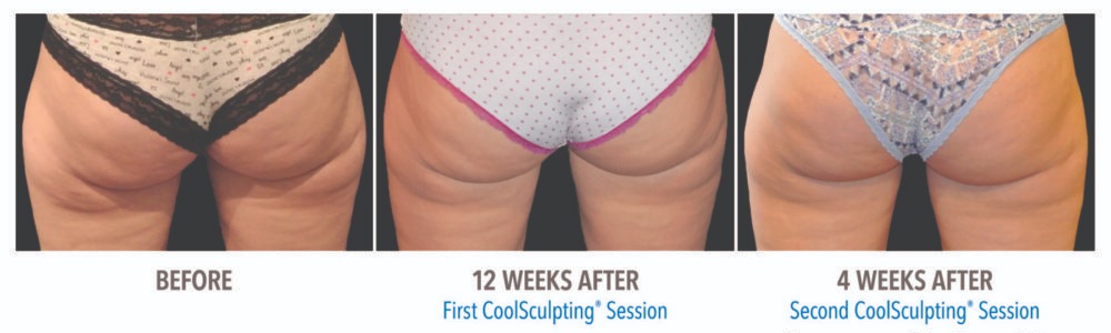 Get Rid of Under The Butt Fat (Banana Rolls) With Coolsculpting