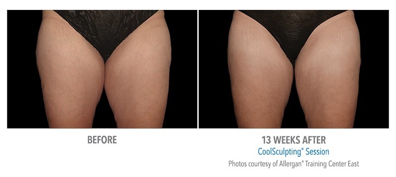 Coolsculpting outer thighs cost new arrivals