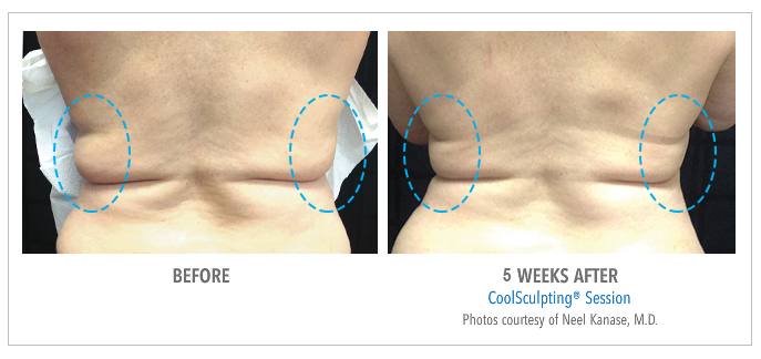 Get Rid of Bra Fat Flanks With Coolsculpting Beverly Hills